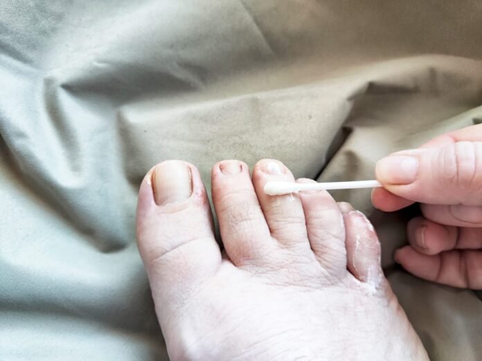 najbolji lak za gljivice na noktima Osoba liječi gljivice na noktima nanošenjem laka za gljivice na zaražene nokte na nogama vatom dok stopalo odmara na svijetloj tkanini.